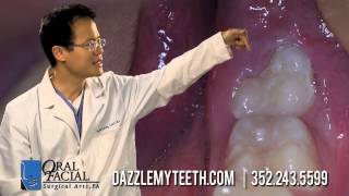 wisdom teeth pain orlando [upl. by Nebe434]