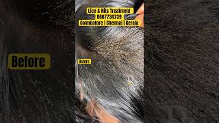 Lice nits removal treatment  lice treatment  lice removal  lice how to remove the nits from hair [upl. by Rosanne]