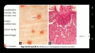 Apurba S Sastry Microbiology Viral Exanthems amp other parvovirus infections part 2 measles amp rubella [upl. by Gusty]