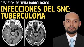 Radiología en 5 minutos Infecciones del sistema nervioso central Tuberculoma [upl. by Delora]