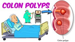 Colonic Polyps [upl. by Ashlin151]