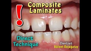 Direct Tehnique Composite Laminates for Gaps Between Teeth [upl. by Hanauq]