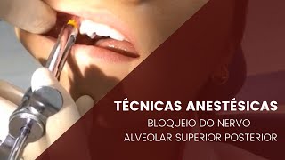 Técnicas anestésicas bloqueio do Nervo Alveolar Posterior [upl. by Christabel]