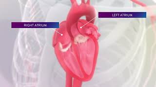 Left Atrial Appendage Occluders Reduce Risk of Stroke in AFib Patients [upl. by Willcox250]