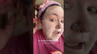 At home dermaplaning before and after skincare dermaplane viral viralproducts viralproduct [upl. by Olimac]