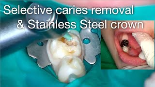 Selective caries removal amp stainless steel crown [upl. by Meador]