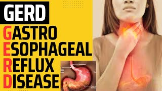 GASTROESOPHAGEAL REFLUX DISEASE  GERD  HEARTBURN  ACID REFLUX  ESOPHAGEAL REFLUX DISEASE [upl. by Evelunn]