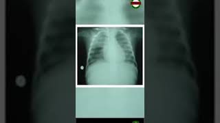 What Is Pulmonary Edema [upl. by Brenk]