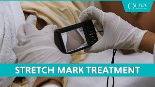 How To Remove Stretch Marks With Pixel Laser Resurfacing amp MNRF Treatments [upl. by Marsiella144]