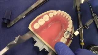 Restoration in Amalgam  30 MO [upl. by Scammon982]