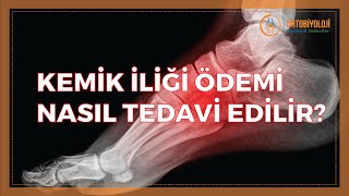 KEMİK İLİĞİ ÖDEMİ NASIL TEDAVİ EDİLİR [upl. by Dis684]