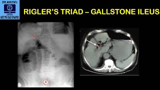 Riglers triad  Gallstone ileus II Understanding the concept [upl. by Murial683]