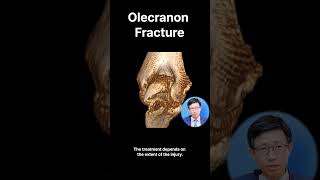 Elbow Olecranon Fracture [upl. by Weiner]