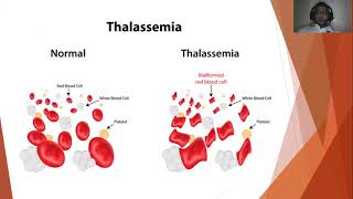 Management of Patients with Nonmalignant Hematologic Disorders Part II [upl. by Rhianon500]