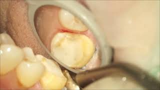 Maxillary first molar crown preparationlimited mouth opening [upl. by Larred427]