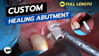 Immediate Implant with Custom Healing Abutment [upl. by Clayborne]