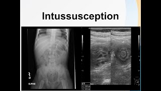 Intussusception [upl. by Kelcie148]