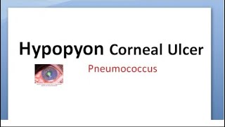 Ophthalmology 112 b Hypopyon Corneal Ulcer Strepcococcus pneumoniae Pneumococcus ulcus serpens [upl. by Akirre62]