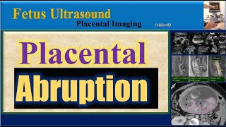 Fetus Ultrasound  Placental Abruption [upl. by Nauqe]