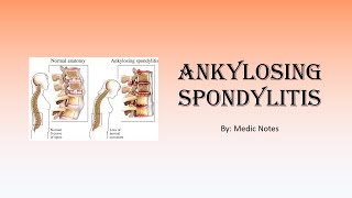 Ankylosing spondylitis  signs and symptoms Schober test Faber test imaging treatment [upl. by Alicirp]