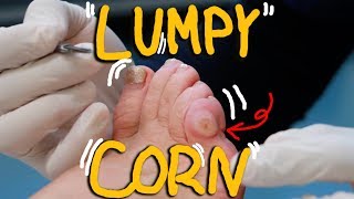 Satisfying Corn Removal with Callus HUGE LUMPY Corn [upl. by Mauricio842]