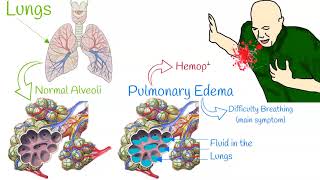 Pulmonary edema  Mechanism of action [upl. by Zobias680]