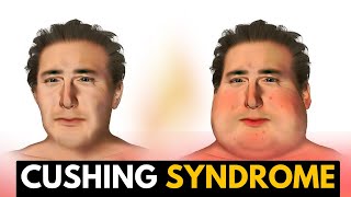 Cushing Syndrome Causes Signs and Symptoms Diagnosis and Treatment [upl. by Olracnaig]