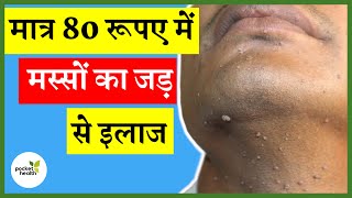 वारटोसिन दवाई का इस्तेमाल कैसे करें  How to Use Wartosin  Best Medicine For Wart Removal [upl. by Luana]