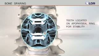 Artificial Disc Replacement Mobi C Product Animation [upl. by Soracco]