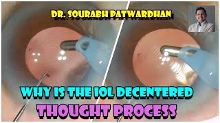 162 Decentered IOL  Thought process Dr Sourabh Patwardhan Can you spot the difference [upl. by Leduar208]