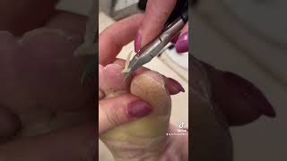 Clipping toe skin callus  Palmoplantar Keratoderma EPPK foot callus shave  Mar 24 2023 [upl. by Mildred999]