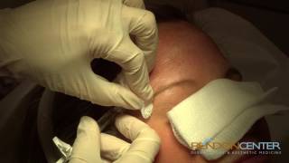 Filler for Forehead Wrinkles procedure [upl. by Ahsla]