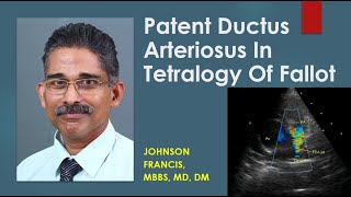 Patent Ductus Arteriosus In Tetralogy Of Fallot [upl. by Llenwahs]