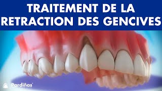 Récession Gingivale – Traitement de la retraction des gencives © [upl. by Reginnej578]