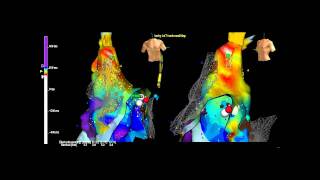 Sinus Node Reentry Tachycardia [upl. by Adnot973]