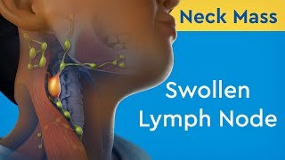 Neck Mass Swollen Lymph Node [upl. by Amian]