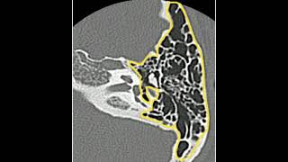 Mastoid Pneumatization [upl. by Mistrot]