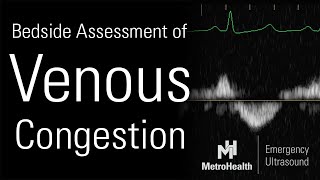 Bedside Assessment of Venous Congestion [upl. by Gaylor869]