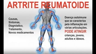 ARTRITE REUMATOIDE Tratamento de Fisioterapia com Terapia Manual  Clínica Dr Robson Sitta [upl. by Asaert]