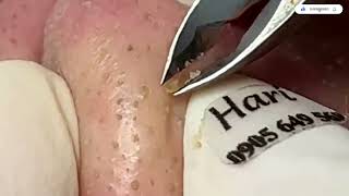 BIG Blackheads Removal on Nose  Acne Treatment 37 [upl. by Ange]