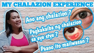 pagkakaiba ng chalazion sa eye styekuliti  my chalazion experience [upl. by Stalder70]