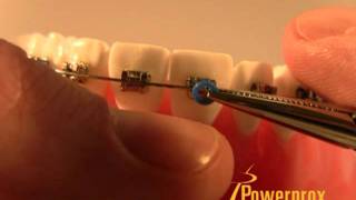 How to Tie an ORing Elastic Powerprox Six Month Braces Orthodontic Education Video [upl. by Betsey49]