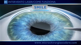 Intervento Laser Occhi Come Funziona [upl. by Chesney]