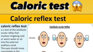 Caloric test explained by practically [upl. by Latton]