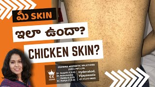 Keratosis Pilaris Treatment in Telugu  Chicken Skin treatment  Dr Deepthi [upl. by Marcellus]