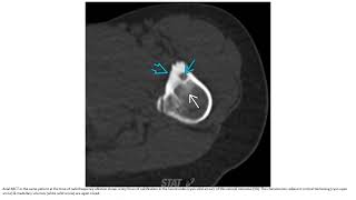 Osteoid Osteoma Imaging [upl. by Erin]