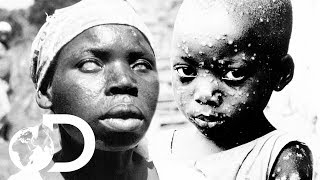 The Eradication Of Smallpox  Invisible Killers [upl. by Ahsauqal]