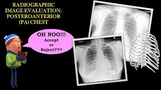 Image Evaluation of PA chest Xray [upl. by Ignace332]