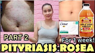 PITYRIASIS ROSEA WHAT’S MY STORY PHILIPPINES [upl. by Ellehcer]