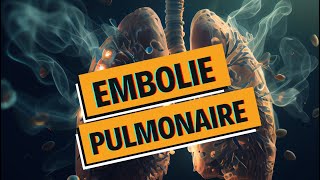 EMBOLIE PULMONAIRE et PHLEBITE  tout comprendre  WhyDoc 1 [upl. by Kirsten689]